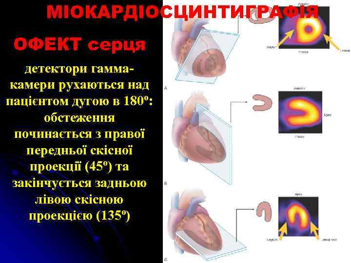 МІОКАРДІОСЦИНТИГРАФІЯ ОФЕКТ серця детектори гаммакамери рухаються над пацієнтом дугою в 180º: обстеження починається з