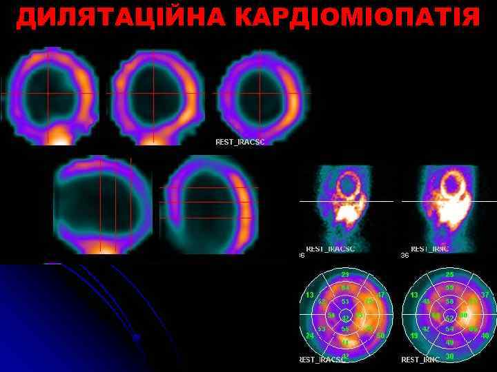 ДИЛЯТАЦІЙНА КАРДІОМІОПАТІЯ 