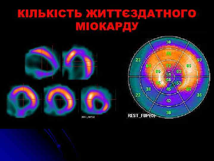 КІЛЬКІСТЬ ЖИТТЄЗДАТНОГО МІОКАРДУ 