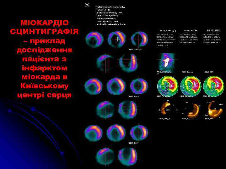 МІОКАРДІО СЦИНТИГРАФІЯ – приклад дослідження пацієнта з інфарктом міокарда в Київському центрі серця 