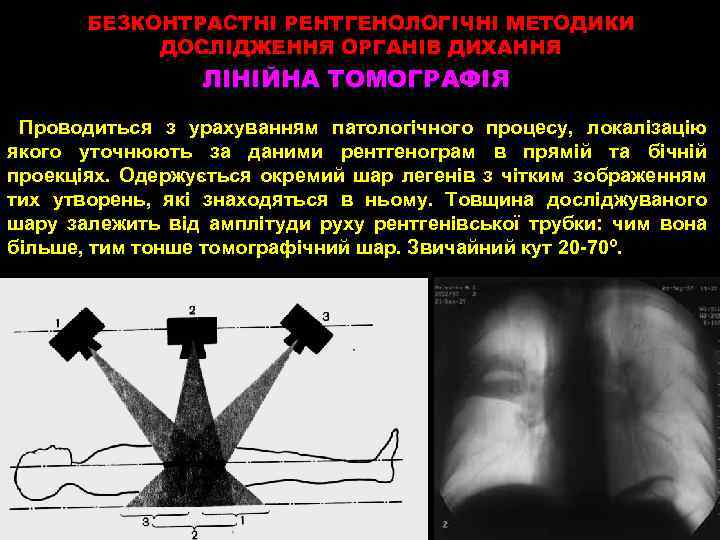БЕЗКОНТРАСТНІ РЕНТГЕНОЛОГІЧНІ МЕТОДИКИ ДОСЛІДЖЕННЯ ОРГАНІВ ДИХАННЯ ЛІНІЙНА ТОМОГРАФІЯ Проводиться з урахуванням патологічного процесу, локалізацію