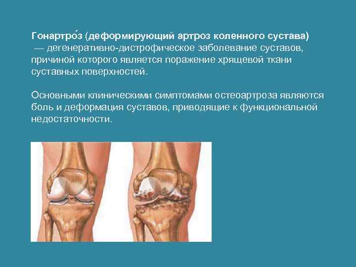 Гонартро з (деформирующий артроз коленного сустава) — дегенеративно-дистрофическое заболевание суставов, причиной которого является поражение