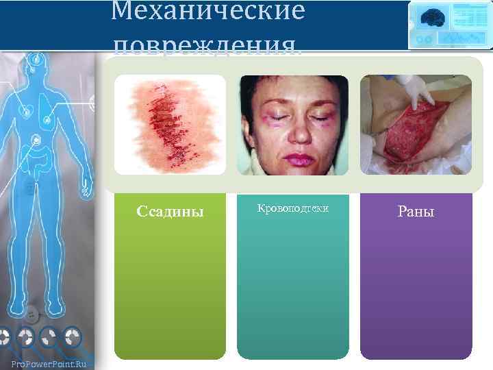 Механические повреждения. Ссадины Pro. Power. Point. Ru Кровоподтеки Раны 