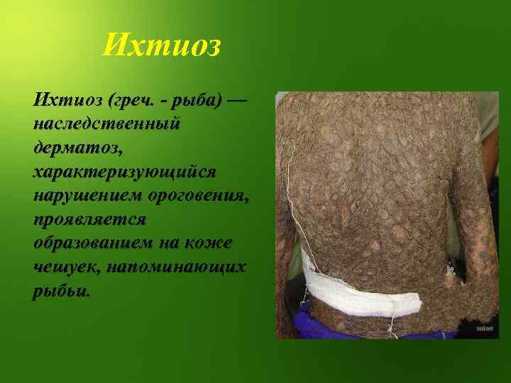 Ихтиоз (греч. - рыба) — наследственный дерматоз, характеризующийся нарушением ороговения, проявляется образованием на коже