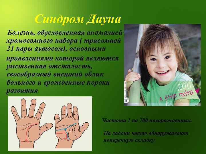 Синдром Дауна Болезнь, обусловленная аномалией хромосомного набора ( трисомией 21 пары аутосом), основными проявлениями