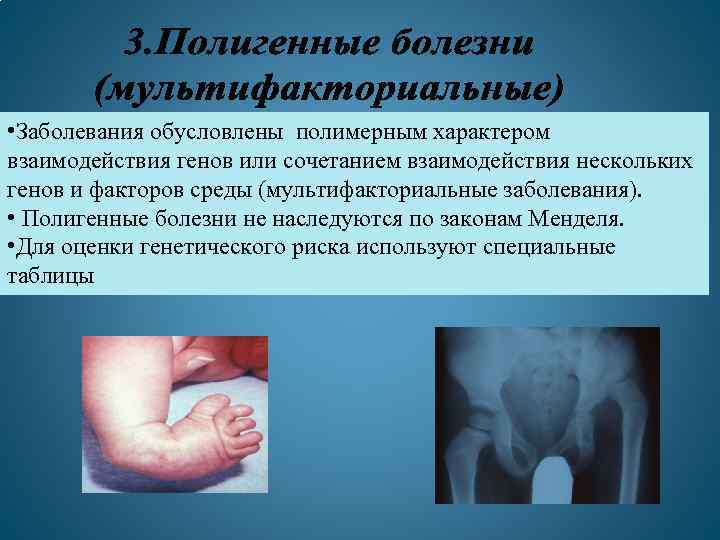  • Заболевания обусловлены полимерным характером взаимодействия генов или сочетанием взаимодействия нескольких генов и