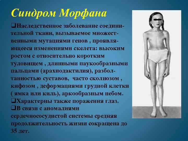 Синдром Морфана q. Наследственное заболевание соединительной ткани, вызываемое множественными мутациями генов , проявляющееся изменениями