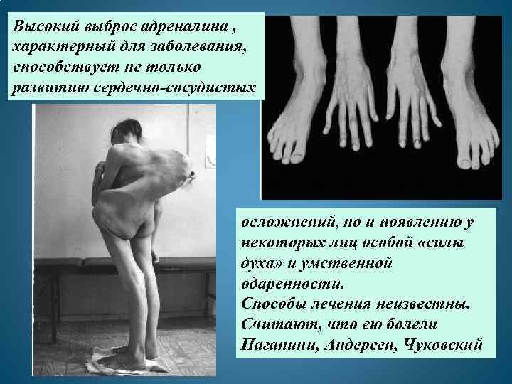 Высокий выброс адреналина , характерный для заболевания, способствует не только развитию сердечно-сосудистых Арахнодактилия –