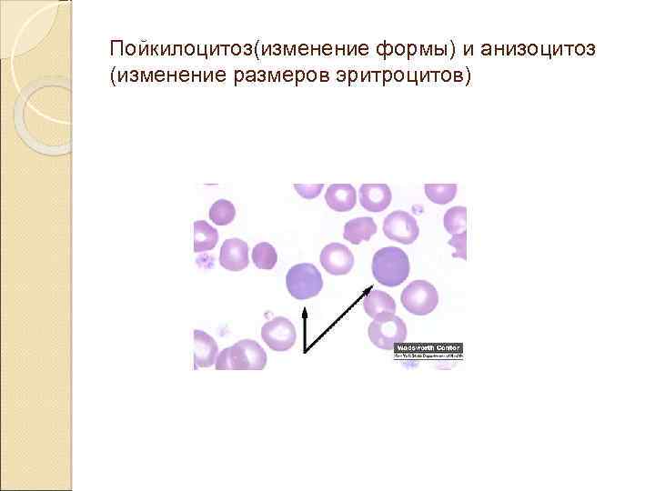 Пойкилоцитоз(изменение формы) и анизоцитоз (изменение размеров эритроцитов) 