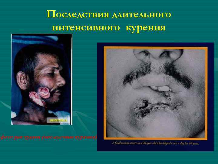 Последствия длительного интенсивного курения фото рак трахеи (последствия курения) 
