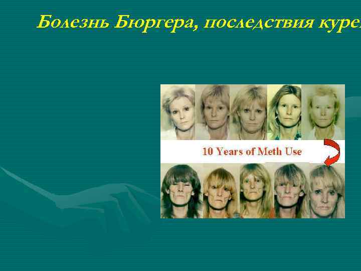 Болезнь Бюргера, последствия курен 