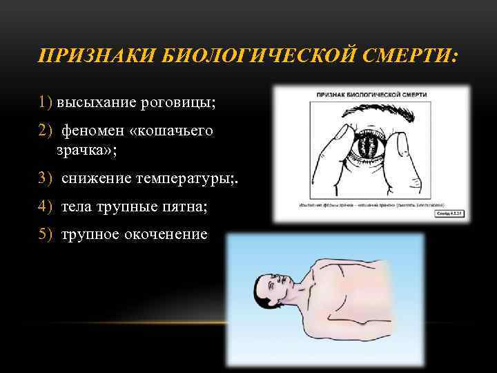 ПРИЗНАКИ БИОЛОГИЧЕСКОЙ СМЕРТИ: 1) высыхание роговицы; 2) феномен «кошачьего зрачка» ; 3) снижение температуры;