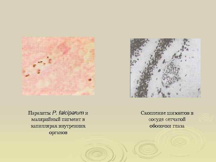Паразиты P. falciparum и малярийный пигмент в капиллярах внутренних органов Скопление шизонтов в сосуде