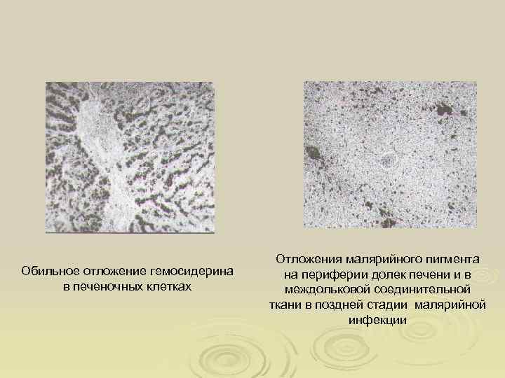 Обильное отложение гемосидерина в печеночных клетках Отложения малярийного пигмента на периферии долек печени и