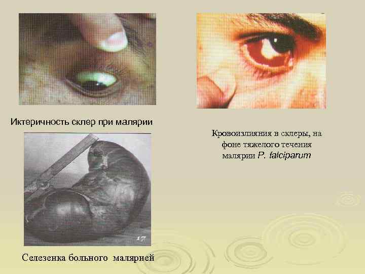Иктеричность склер при малярии Кровоизлияния в склеры, на фоне тяжелого течения малярии P. falciparum