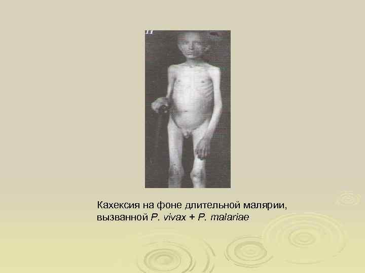 Кахексия на фоне длительной малярии, вызванной P. vivax + P. malariae 