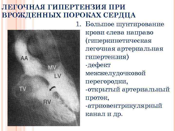 ЛЕГОЧНАЯ ГИПЕРТЕНЗИЯ ПРИ ВРОЖДЕННЫХ ПОРОКАХ СЕРДЦА 1. Большое шунтирование крови слева направо (гиперкинетическая легочная