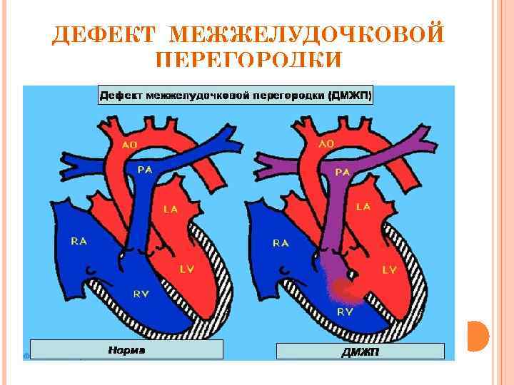 Гемодинамика дмжп у детей схема