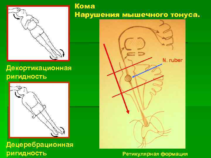 Кома сроки