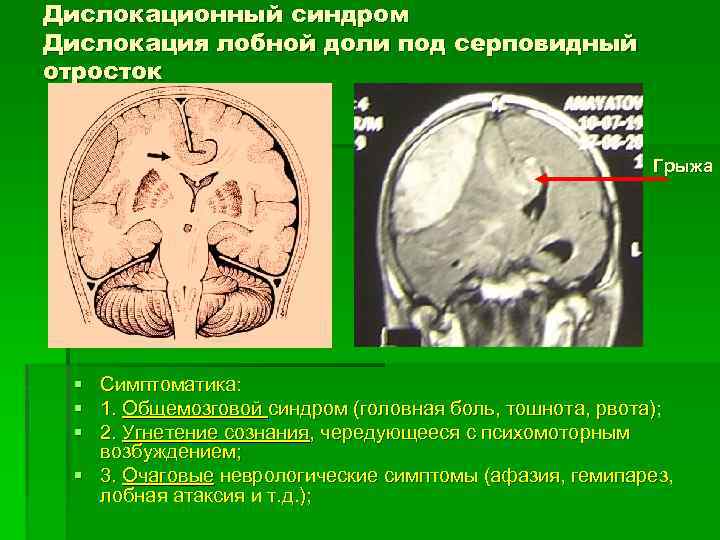 Дислокационный синдром Дислокация лобной доли под серповидный отросток Грыжа § Симптоматика: § 1. Общемозговой