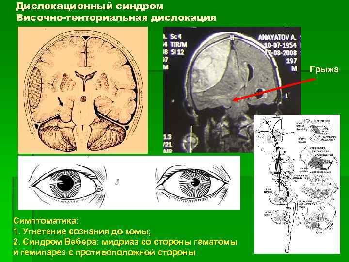 Дислокация мозгах