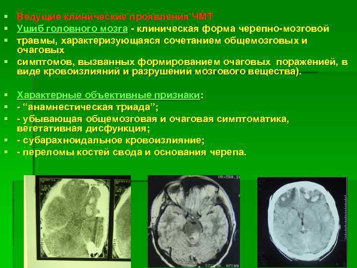 § § § Ведущие клинические проявления ЧМТ Ушиб головного мозга - клиническая форма черепно-мозговой