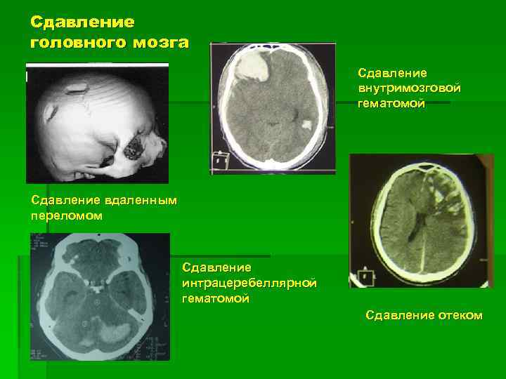 Сдавление головного мозга картинки