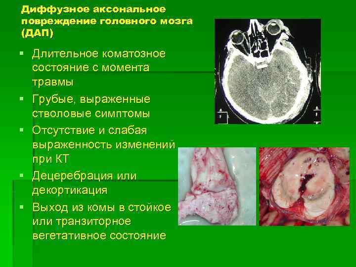 Диффузное аксональное повреждение головного мозга (ДАП) § Длительное коматозное состояние с момента травмы §