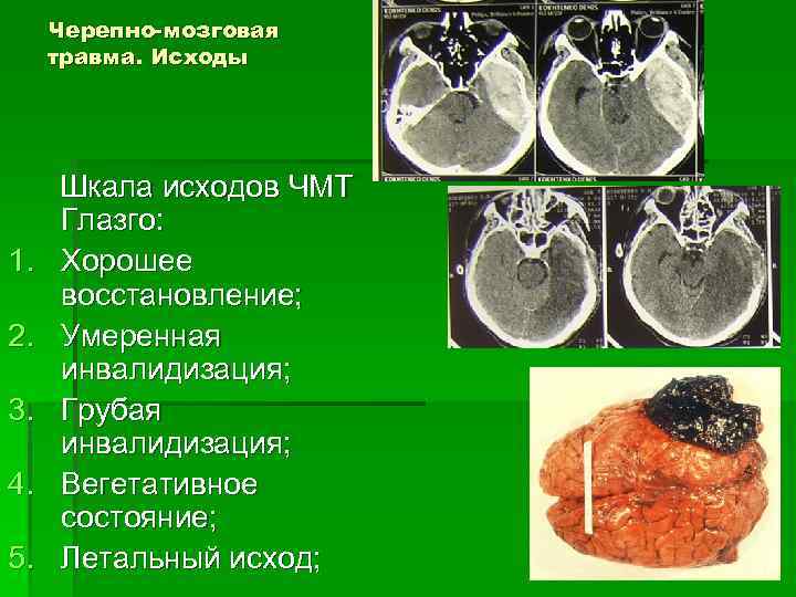 Черепно-мозговая травма. Исходы 1. 2. 3. 4. 5. Шкала исходов ЧМТ Глазго: Хорошее восстановление;