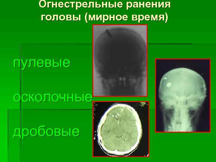 Огнестрельные ранения головы (мирное время) пулевые осколочные дробовые 