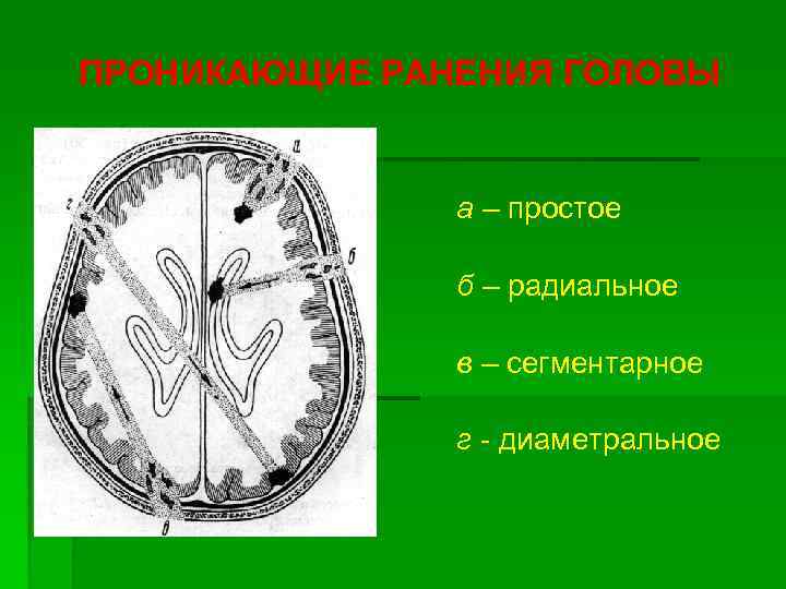 ПРОНИКАЮЩИЕ РАНЕНИЯ ГОЛОВЫ а – простое б – радиальное в – сегментарное г -