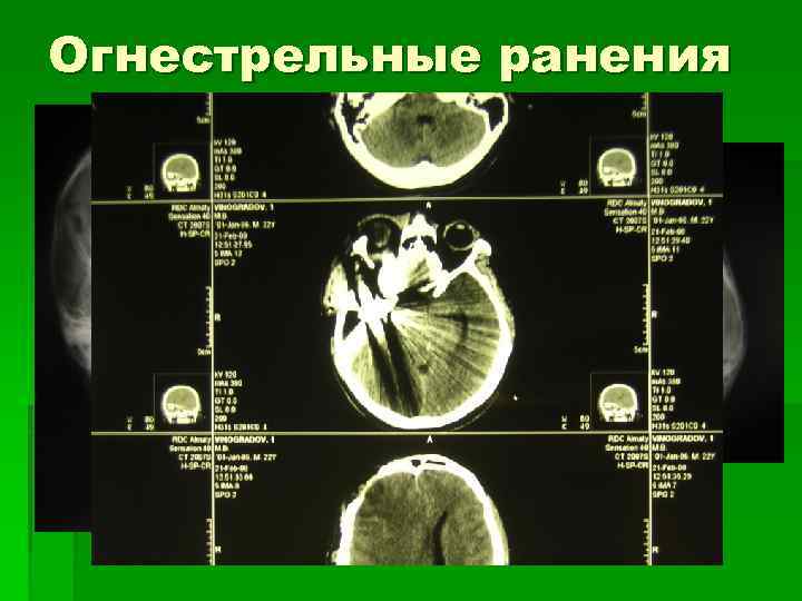 Огнестрельные ранения головы 