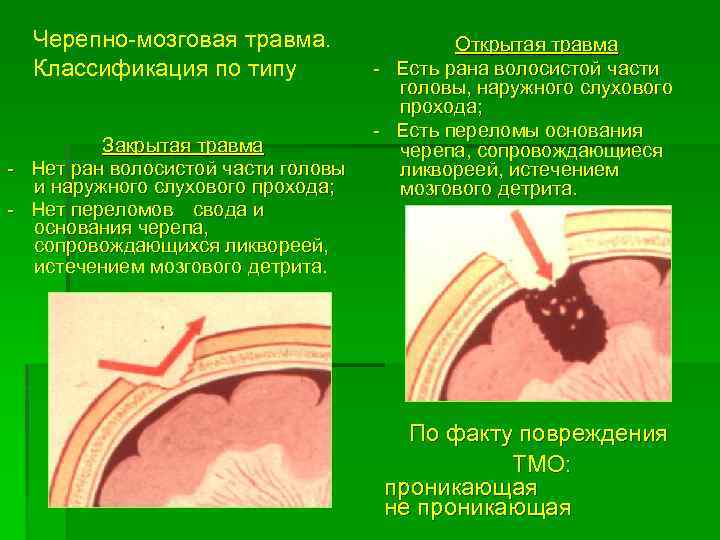 Черепно-мозговая травма. Классификация по типу Закрытая травма - Нет ран волосистой части головы и