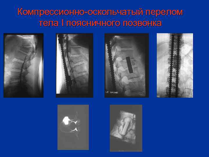 Компрессионно-оскольчатый перелом тела I поясничного позвонка 