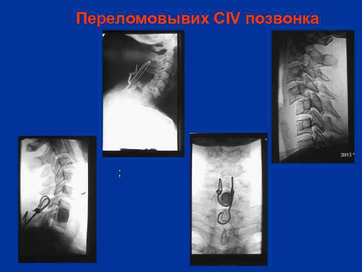 Переломовывих CIV позвонка ; 