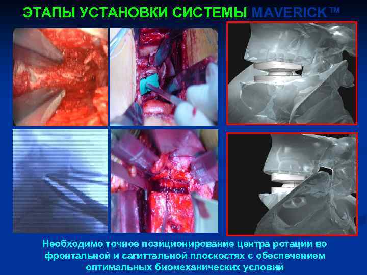 ЭТАПЫ УСТАНОВКИ СИСТЕМЫ MAVERICK™ Необходимо точное позиционирование центра ротации во фронтальной и сагиттальной плоскостях