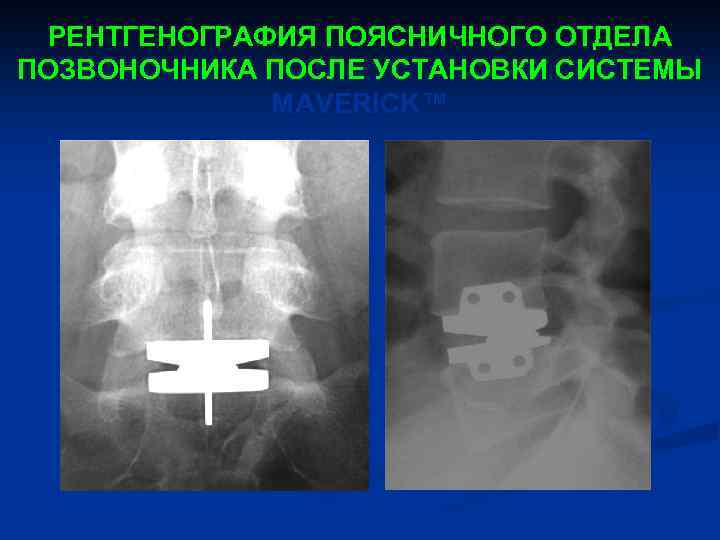 РЕНТГЕНОГРАФИЯ ПОЯСНИЧНОГО ОТДЕЛА ПОЗВОНОЧНИКА ПОСЛЕ УСТАНОВКИ СИСТЕМЫ MAVERICK™ 