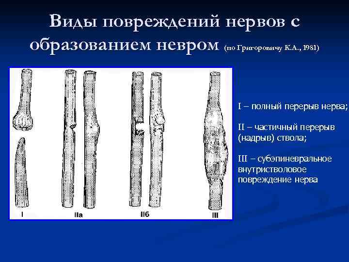 Виды повреждений нервов с образованием невром (по Григоровичу К. А. , 1981) I –