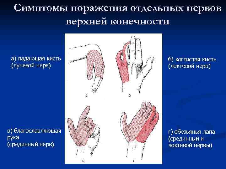 Симптомы поражения отдельных нервов верхней конечности а) падающая кисть (лучевой нерв) б) когтистая кисть