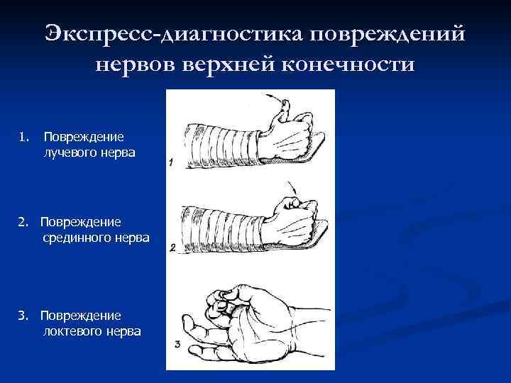 Экспресс-диагностика повреждений нервов верхней конечности 1. Повреждение лучевого нерва 2. Повреждение срединного нерва 3.