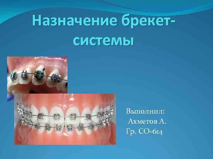 Назначение брекетсистемы Выполнил: Ахметов А. Гр. СО-614 
