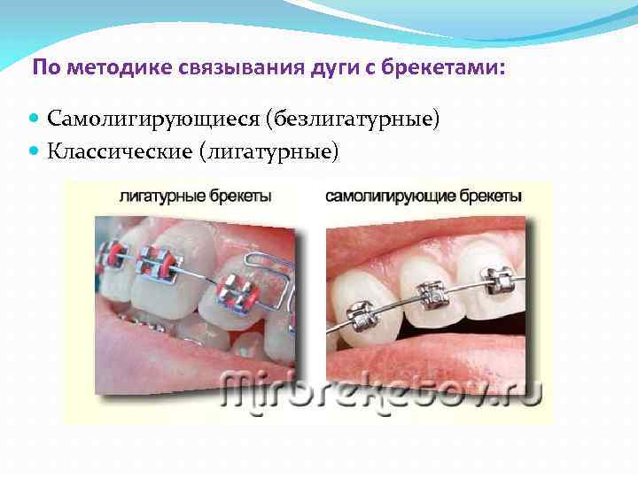 По методике связывания дуги с брекетами: Самолигирующиеся (безлигатурные) Классические (лигатурные) 