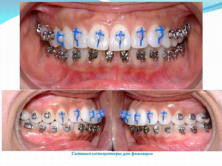 Съемные позиционеры для фиксации 