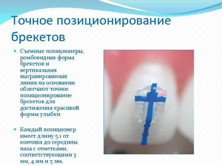 Точное позиционирование брекетов Съемные позиционеры, ромбовидная форма брекетов и вертикальная выгравированная линия на основании