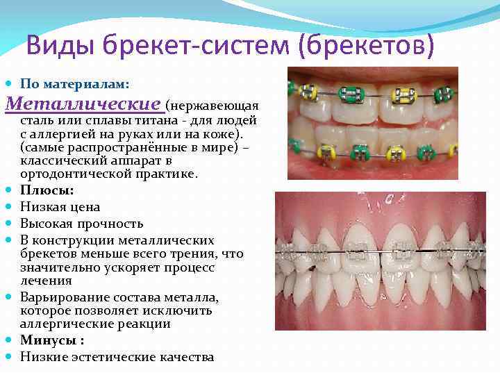 Виды брекет-систем (брекетов) По материалам: Металлические (нержавеющая сталь или сплавы титана - для людей