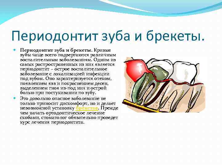 Периодонтит зуба и брекеты. Кривые зубы чаще всего подвергаются различным воспалительным заболеваниям. Одним из