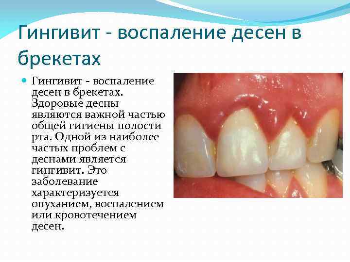 Гингивит - воспаление десен в брекетах Гингивит - воспаление десен в брекетах. Здоровые десны
