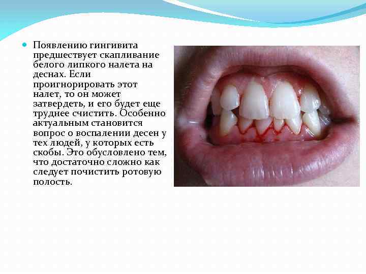  Появлению гингивита предшествует скапливание белого липкого налета на деснах. Если проигнорировать этот налет,