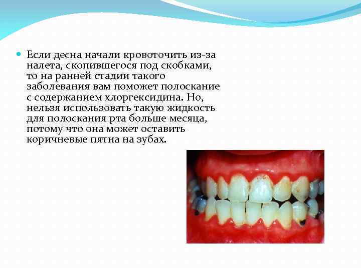  Если десна начали кровоточить из-за налета, скопившегося под скобками, то на ранней стадии