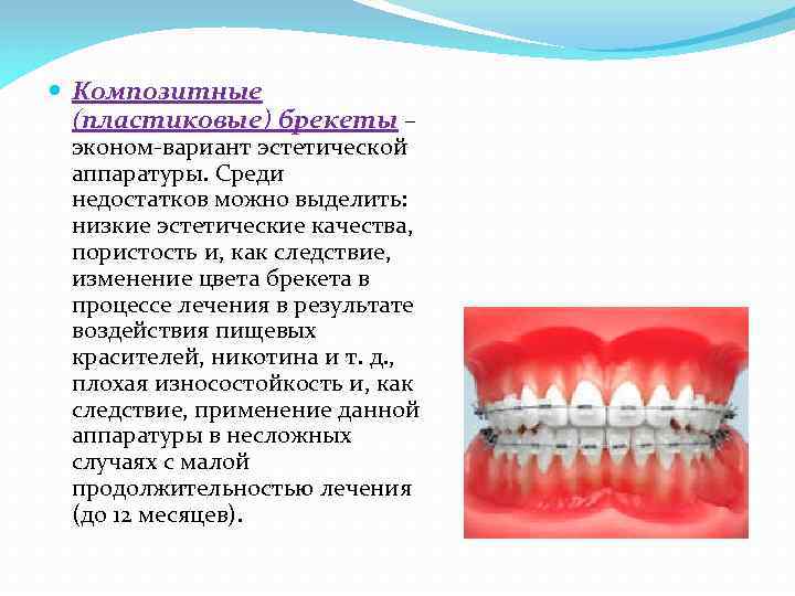  Композитные (пластиковые) брекеты – эконом-вариант эстетической аппаратуры. Среди недостатков можно выделить: низкие эстетические